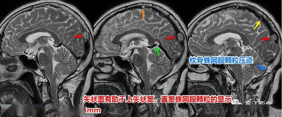 太精華了頭顱mri入門之易誤診影像系列