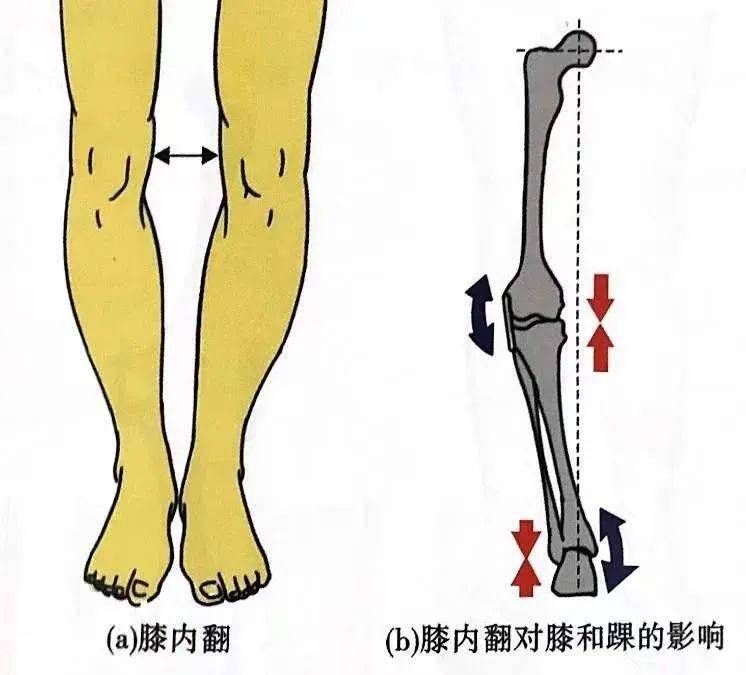 在膝内翻时,膝关节内侧间隙变窄,组织受压会增加(表9