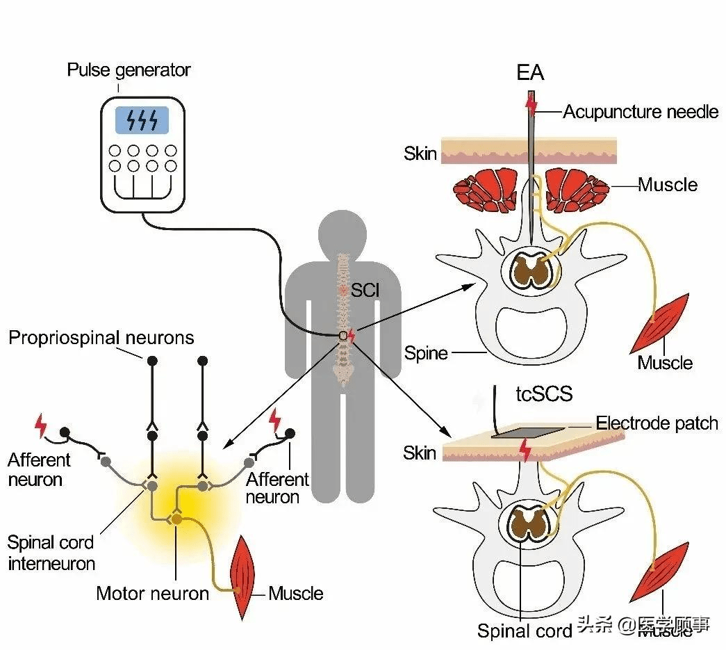 干细胞源性神经元联合功能性电刺激重构神经环路精准修复脊髓损伤