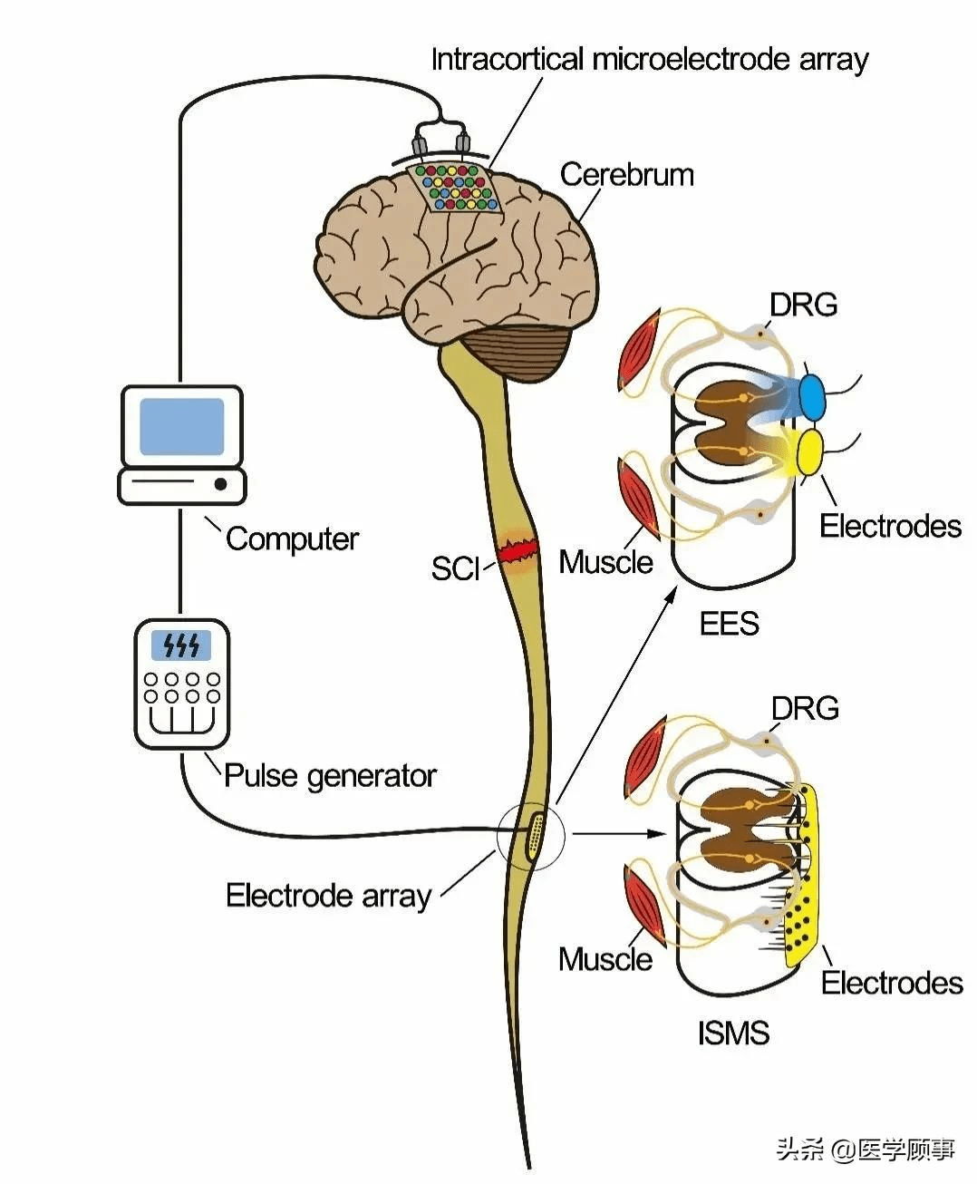 干细胞源性神经元联合功能性电刺激重构神经环路精准修复脊髓损伤