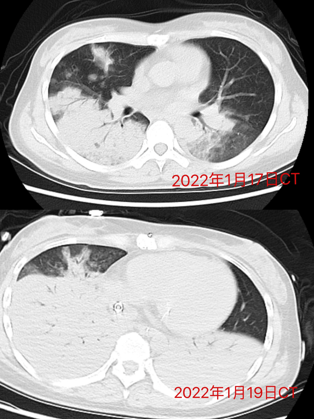致命的鹦鹉热衣原体重症肺炎急诊医学中心ecmo辅助下救治我院首例鹦鹉