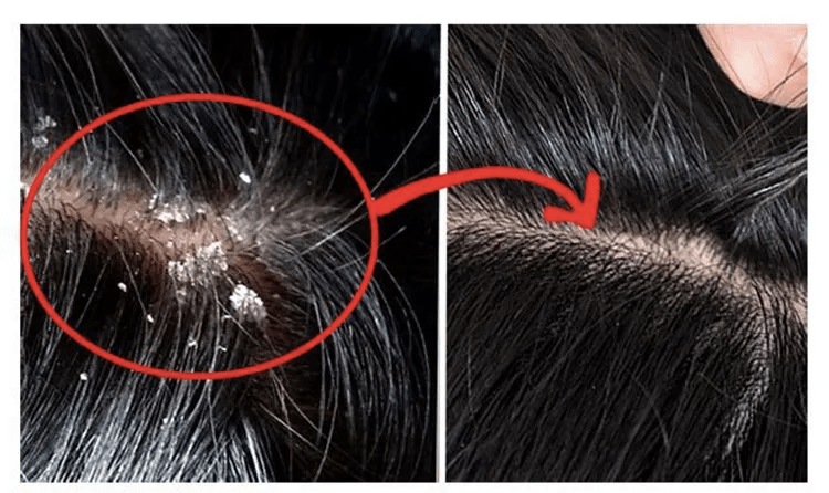 尸体头上抠下来的白泥竟是螨虫尸体!头痒头屑出油多,用它就对了