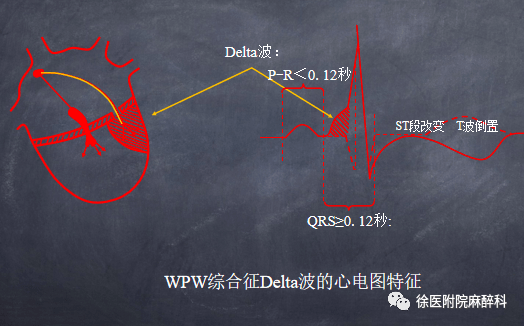 专题| 预激综合征的麻醉管理(徐医附院麻醉科)_心电图_旁路_窦性
