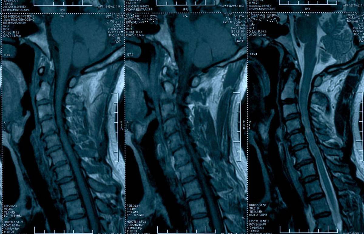 磁共振片子,六位片每一种检查都传递了疾病的各种信息_成像_情况_颈椎