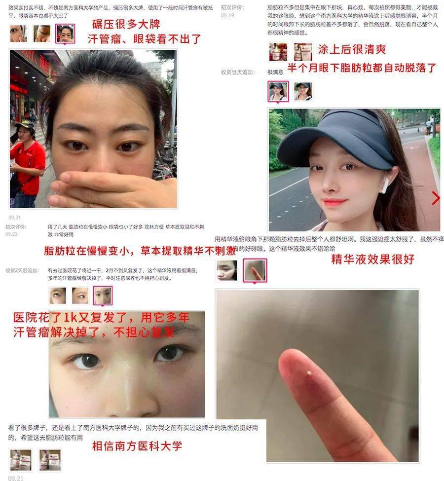 医学长了脂肪粒到底挤不挤?一分钟教你处理它的正确姿势!