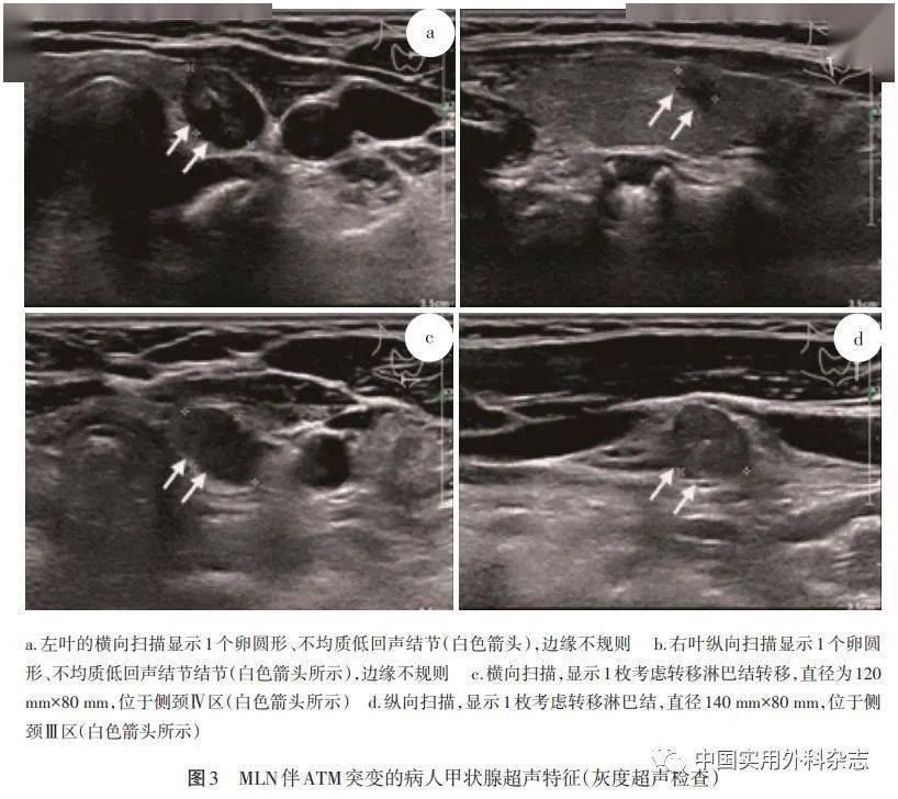 論著利用高通量測序技術檢測甲狀腺乳頭狀癌基因變異的臨床研究