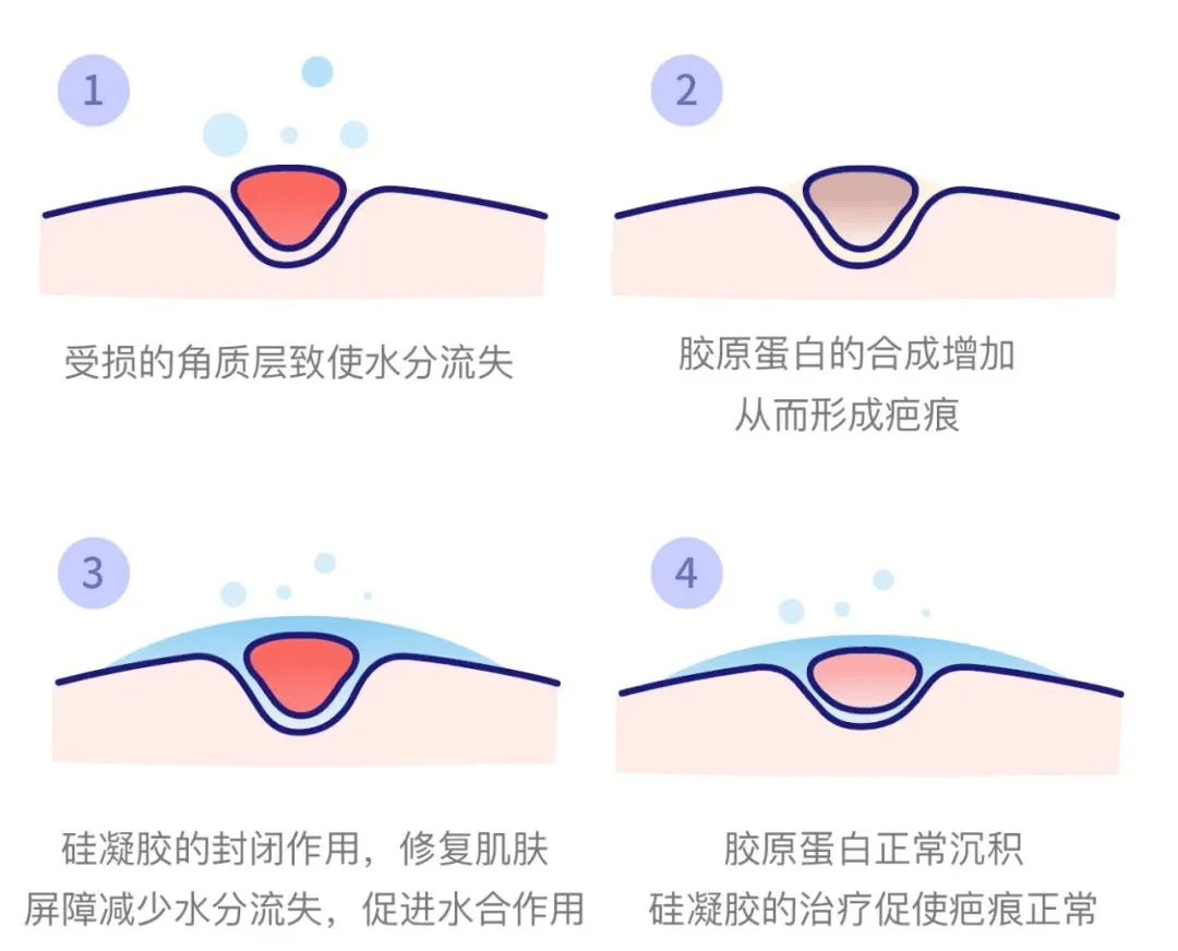 一期愈合和二期愈合图片