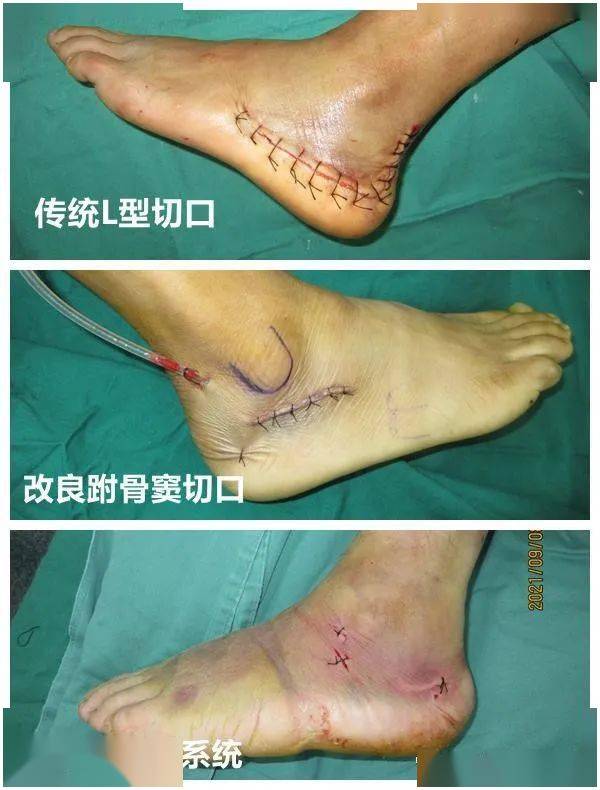泉州仁福骨外科医院成功开展跟骨钉中钉系统微创手术_患者_切口_我院