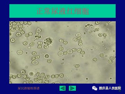 尿红细胞形态报告单图片