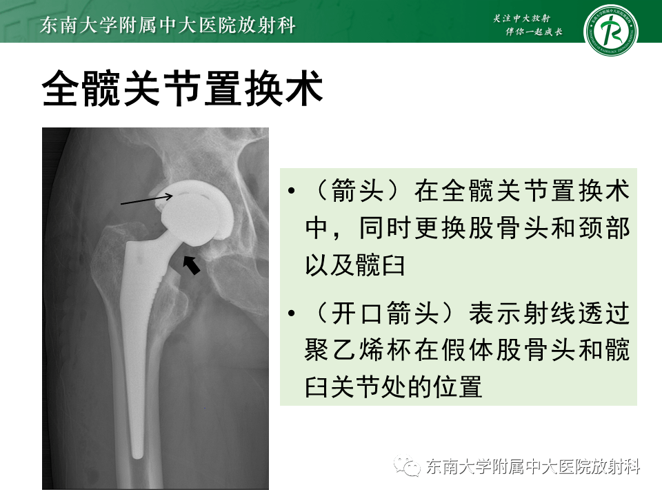 77pg/ml;降钙素原:0.