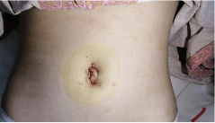 小丽|13岁少女突发腹痛竟是妇科急症，广州医生单孔腹腔镜剥囊肿