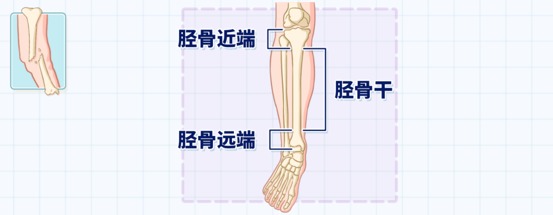 小腿骨折 除了打钢板 还有别的治疗方式吗 胫骨 手术 移位