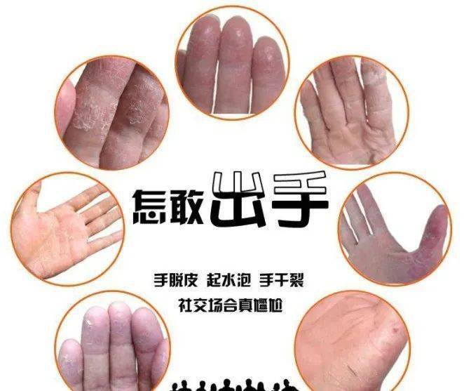 春季来临:手部湿疹vs手癣,怎么区分呢?