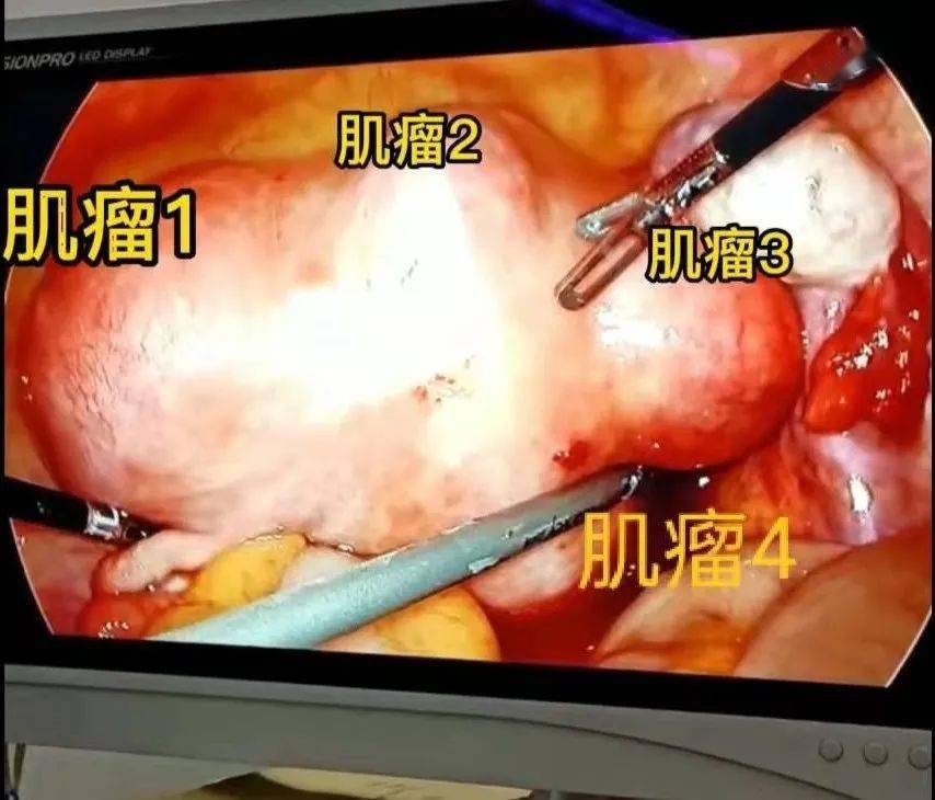 3公分子宫肌瘤图片图片