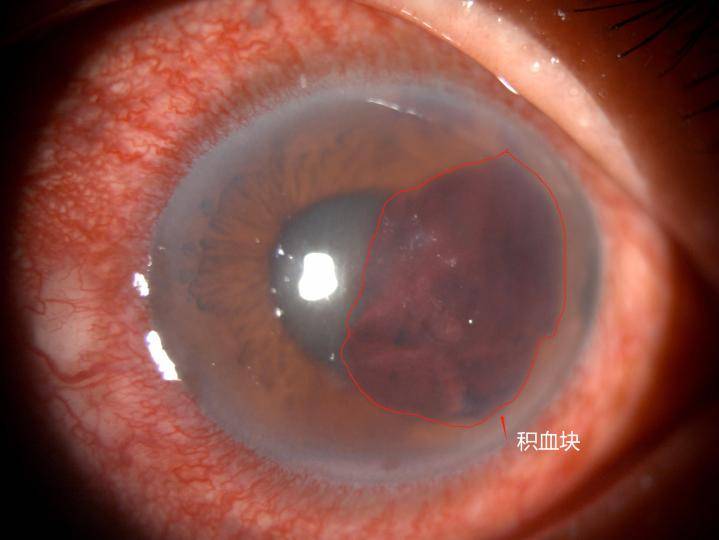 医生提醒:炸伤后不要用水清洗眼睛!_mmhg_袁煜宗_眼压