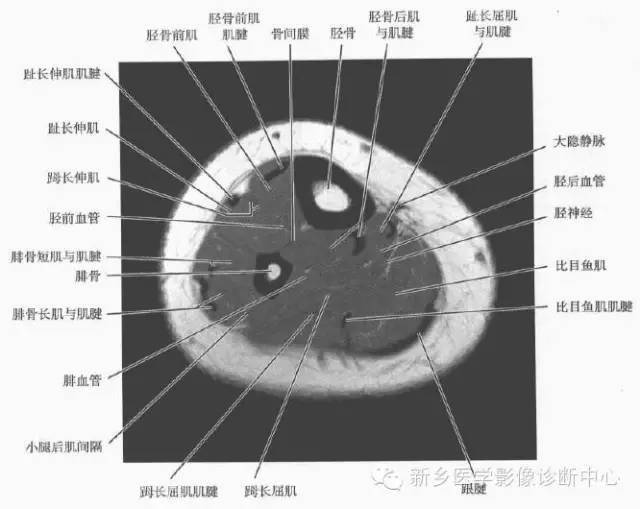 小腿部断层解剖 详细标注_全网_影像_系统