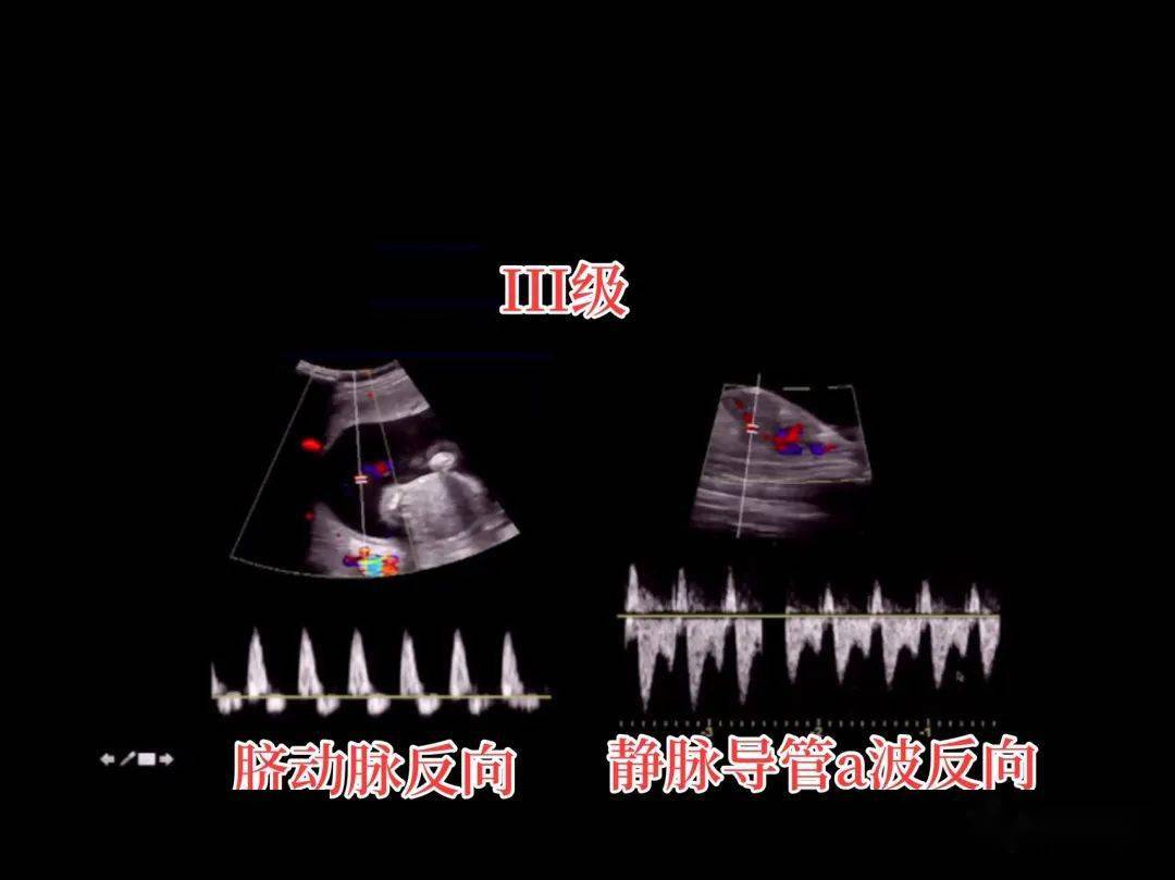 实例讲解双胎输血综合征记忆法_血流_静脉_膀胱