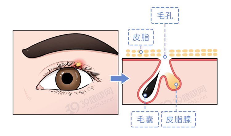 脓肿范围较小一般是睫毛根部皮脂腺发炎另一种是外麦粒肿2