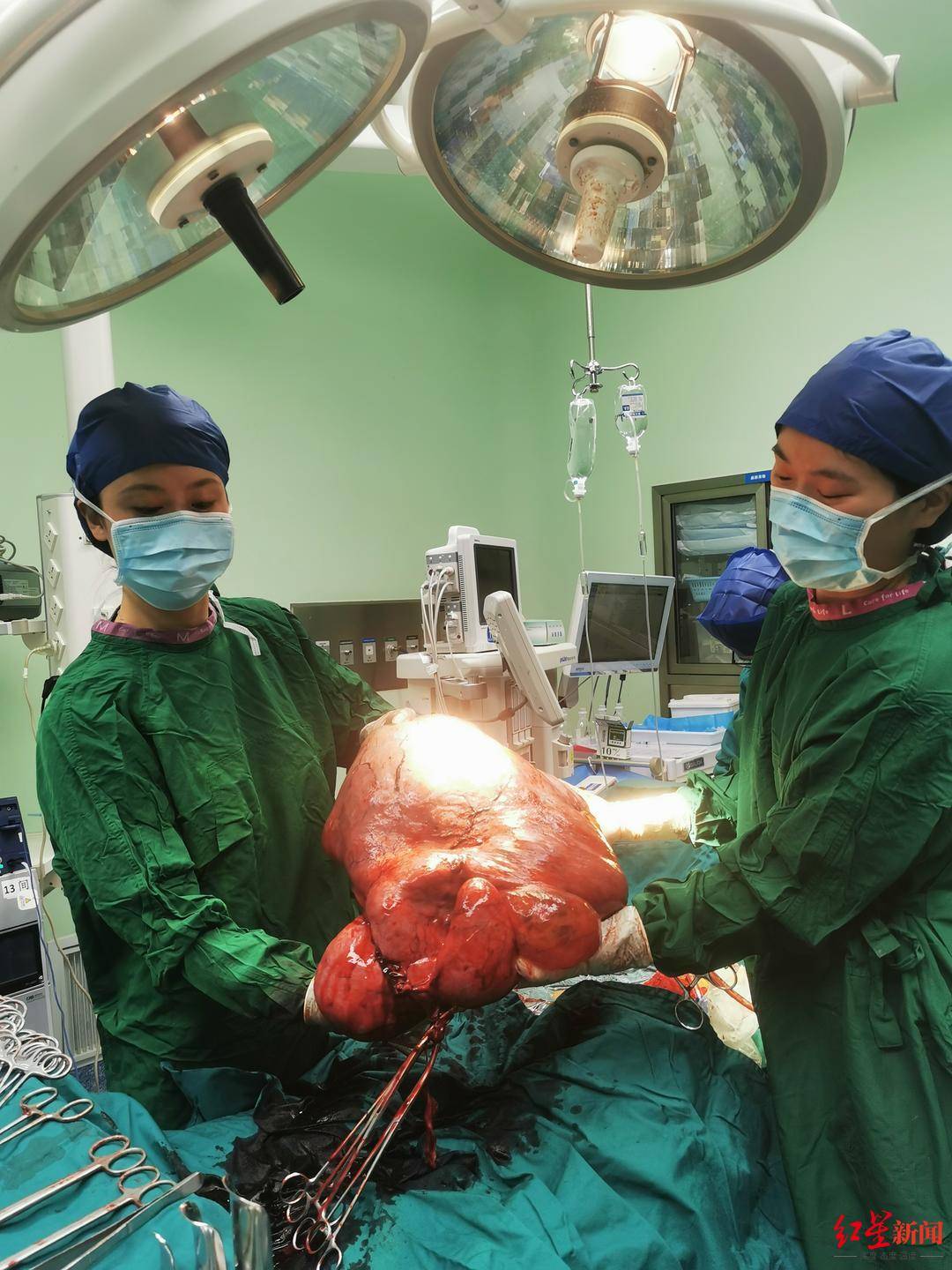 肿瘤|肚子突然膨胀！42岁女子腹大如怀双胞胎 手术取出20多斤重巨型肿瘤