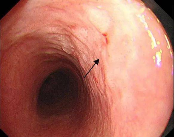 食管肿瘤早期症状图片图片