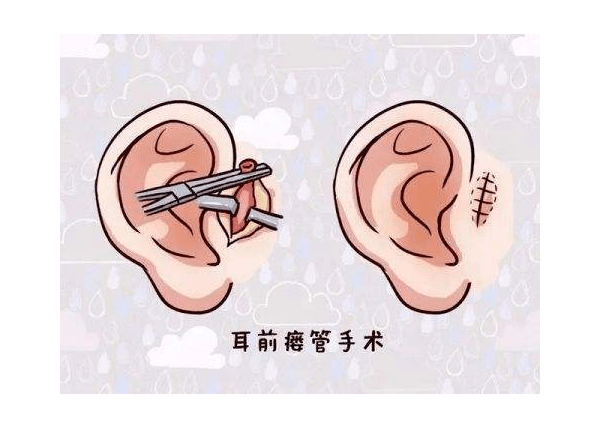 惊呆了聪明孔原来是先天性外耳畸形