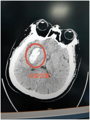 血压高|得了“三高”一直没治 36岁男子除夕夜脑出血进医院