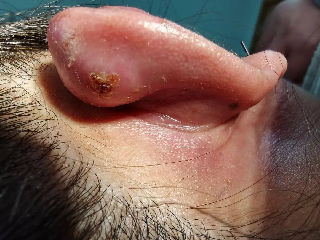 的红肿并未消失,反而越肿越大了,伴随着疼痛,而且慢慢地开始流黄脓水