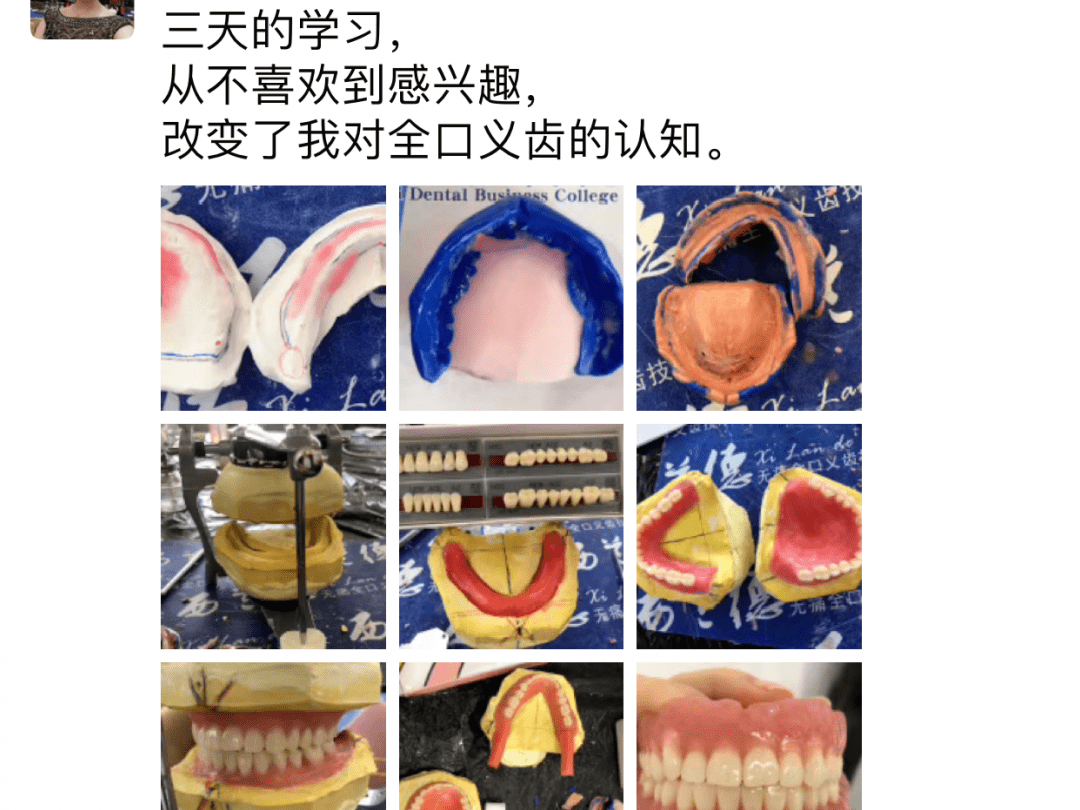 學術分享吸附性義齒對全口無牙頜患者義齒穩定性語言能力和咀嚼功能的