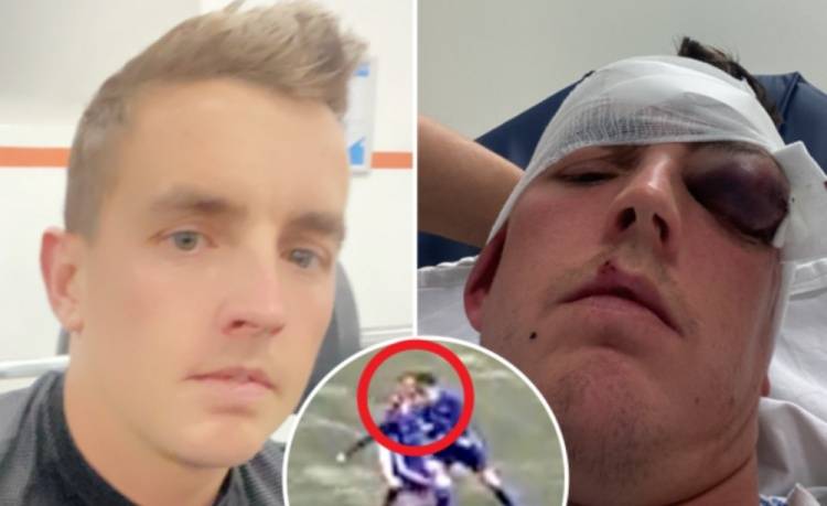 对手|暴力??苏格兰一球员遭对手故意头部顶撞，眼睛肿成高尔夫球大小