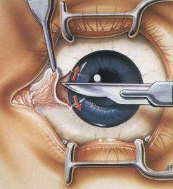 翼状胬肉的手术操作要点(内附手术)_防控_结膜_角膜