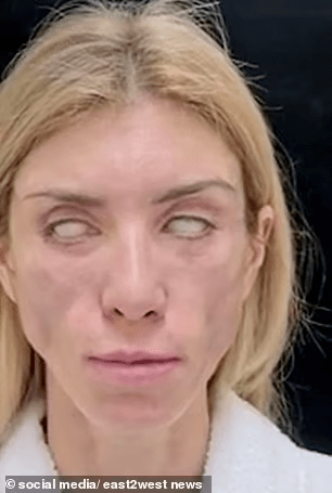 俄罗斯选美皇后整容失败美女变僵尸无法闭眼微笑