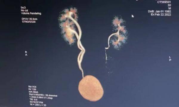 输尿管|郑州一男子长了三个肾！专家：常见病，会遗传