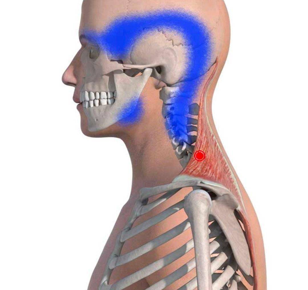 肩胛提肌扳机点图片