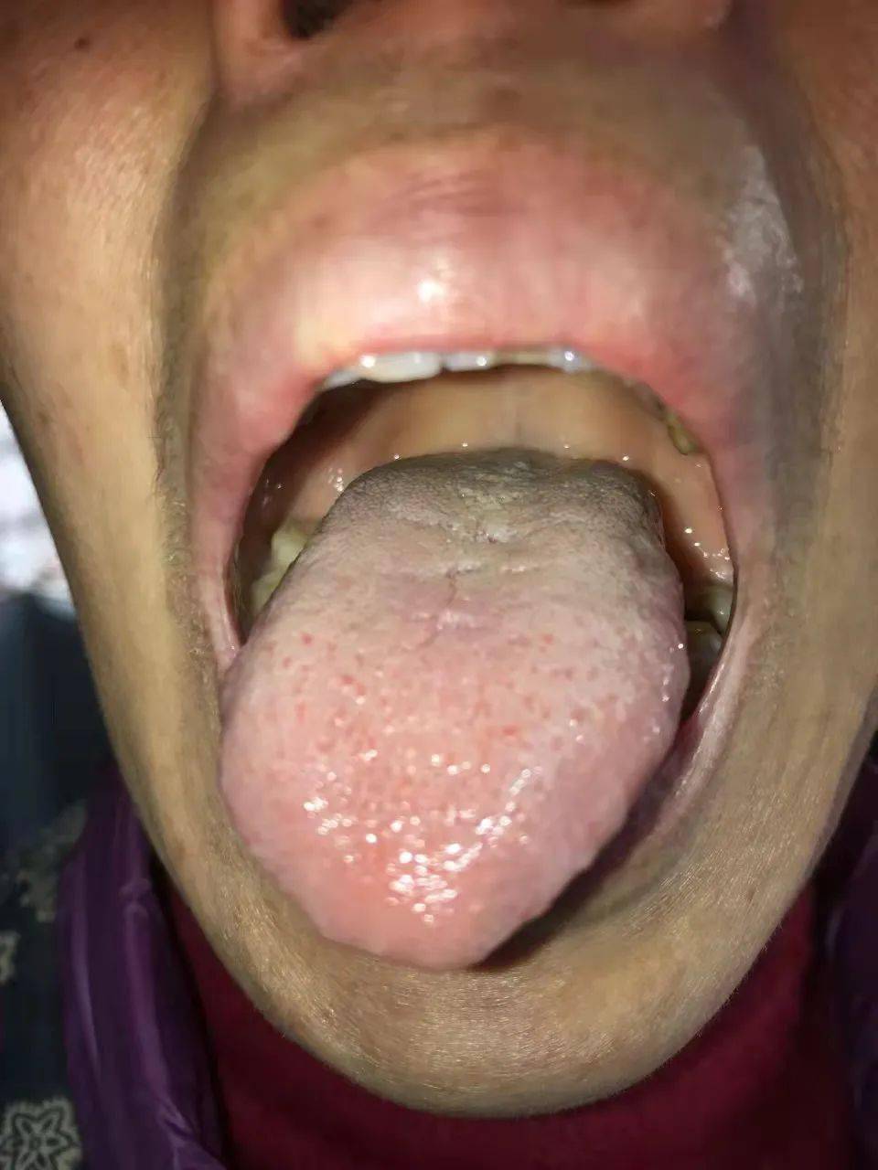 以上两张图片是选自奇效舌诊发明人李芳祥老师开具舌诊中药方的两张