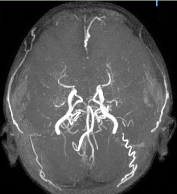 右侧额叶异常信号,考虑陈旧性脑梗塞并部分软化灶形成可能性大,桥脑