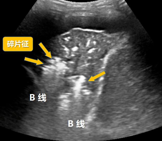 肺超声在肺实变中能辨识哪些肺组织结构