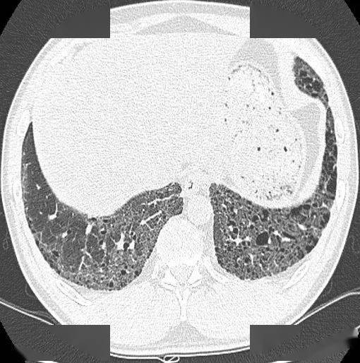 这个间质性肺炎还挺少见的