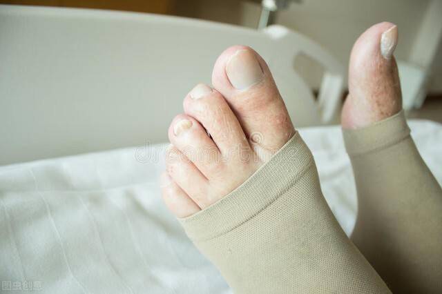 弹力袜|治疗下肢静脉曲张的弹力袜，你选对了吗？