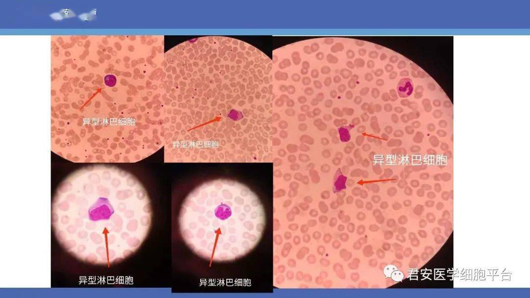 单核细胞病理_单个细胞综合症_单核细胞综合症