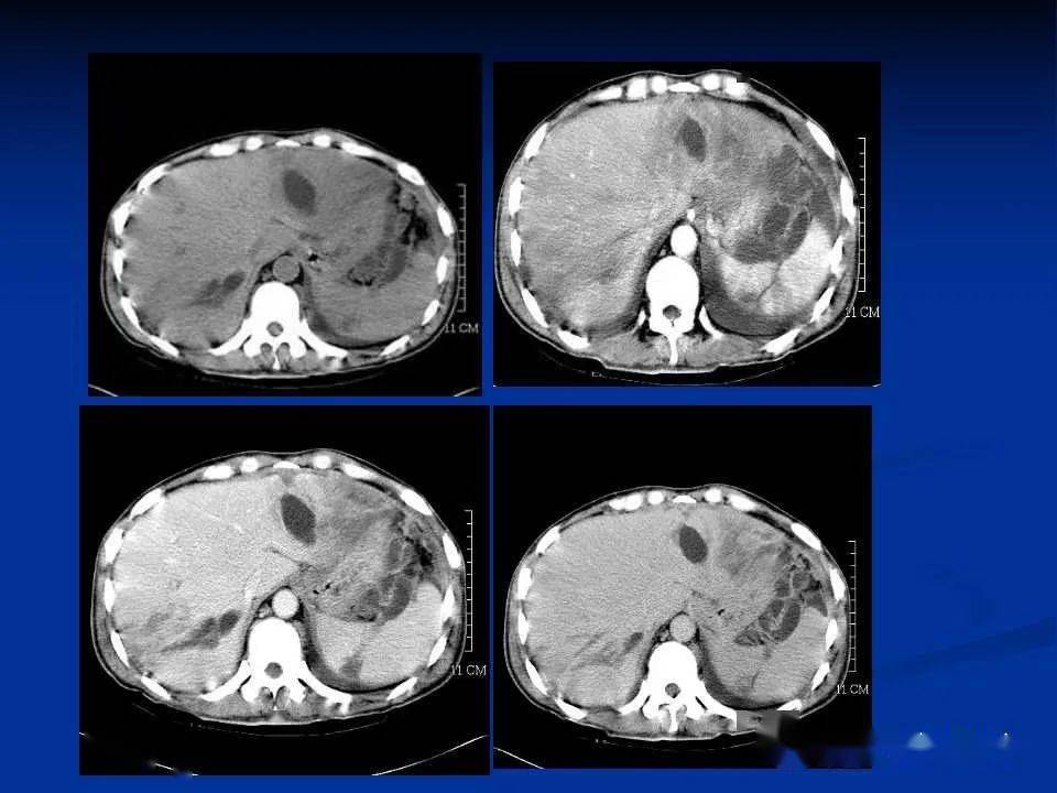 脾脏病变ct诊断 一文全!_平台_肿瘤_常读