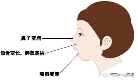 孩子睡覺愛張嘴聽說這樣會變醜