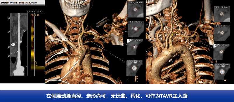 吉林大學白求恩第一醫院完成一例腋動脈入路橫位心高難度tavr手術