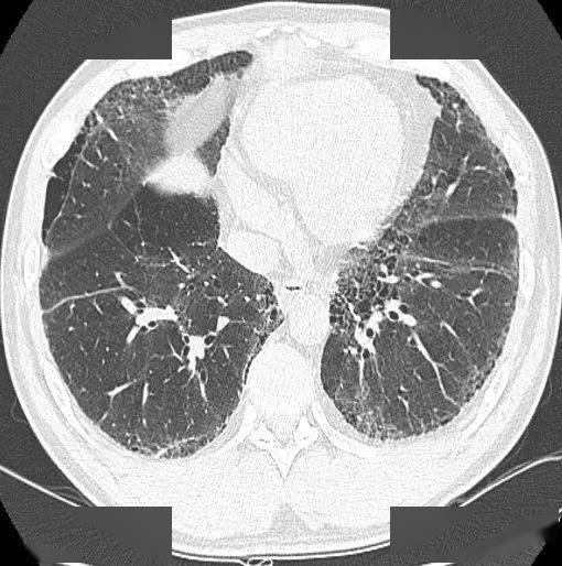 胸部|这个间质性肺炎，还挺少见的