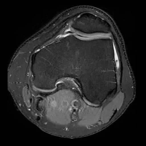 髌骨软化核磁共振图像图片