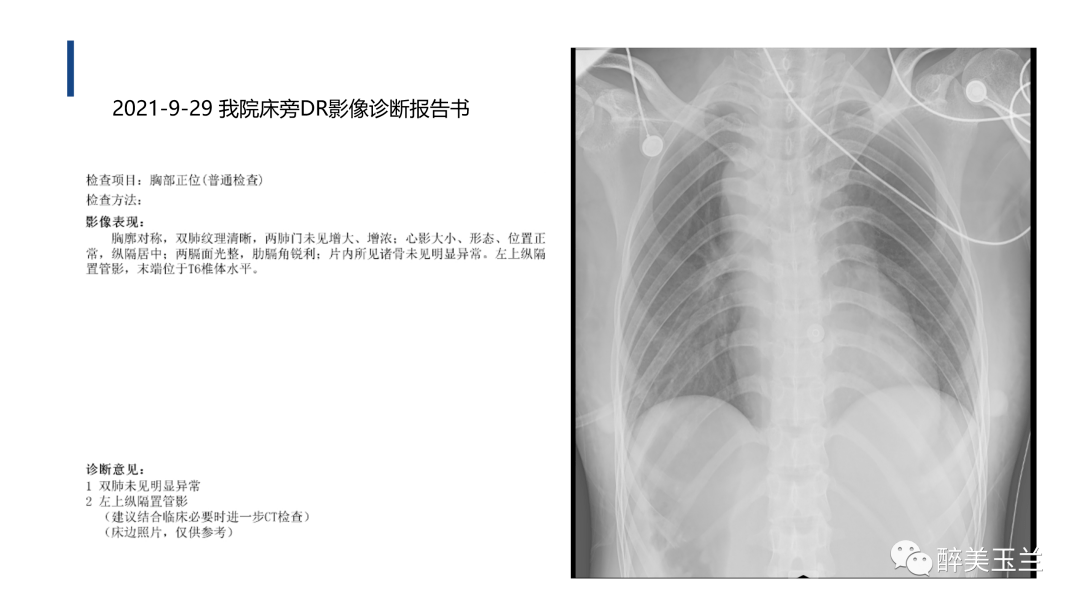 病例讨论妊娠合并复杂先心病剖宫产麻醉管理回看开放