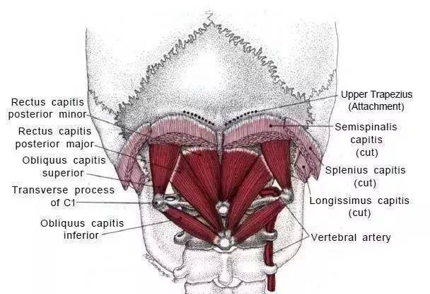诱发偏头痛的常见肌筋膜触发点及其解剖定位