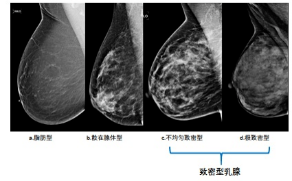 女神节,让我们关爱女性健康,聊聊乳腺钼靶检查那些事