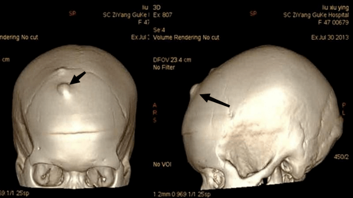 【名医科普】发现宝贝头面部包块怎么办?_肿物_检查_颅骨