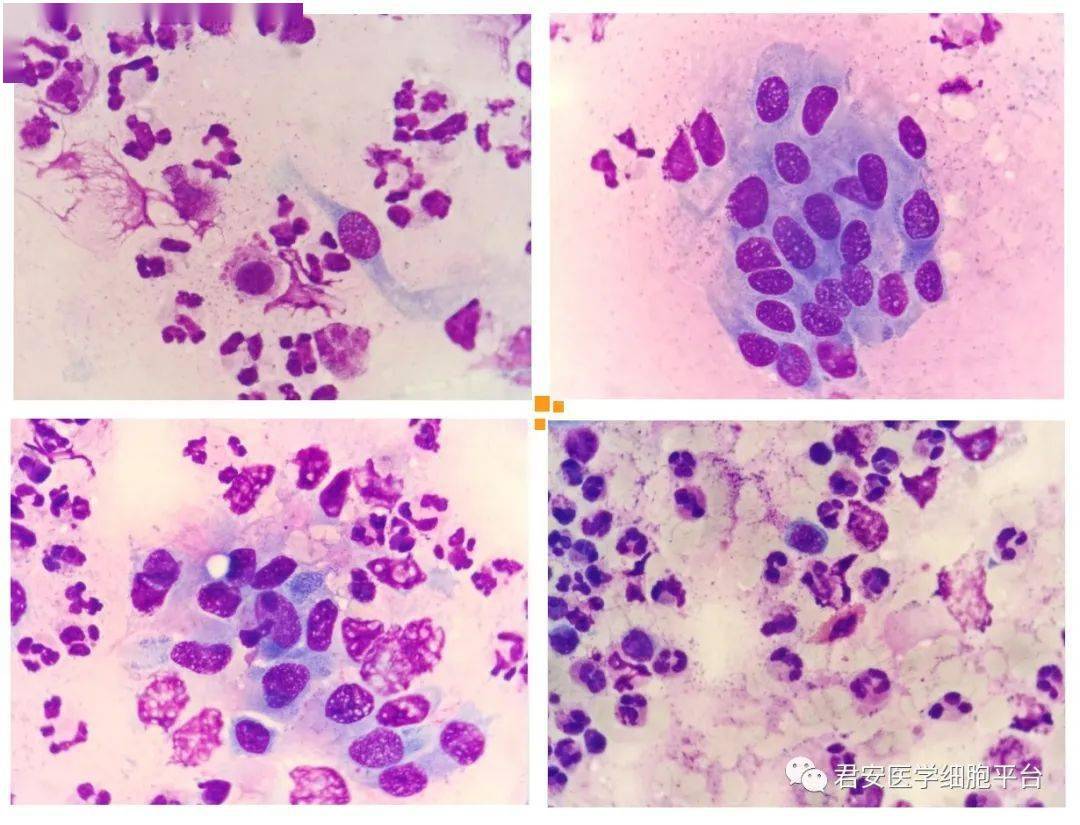 检验诊断毛刷:柱状上皮细胞易见,可见较多中性粒细胞,偶见嗜酸性粒