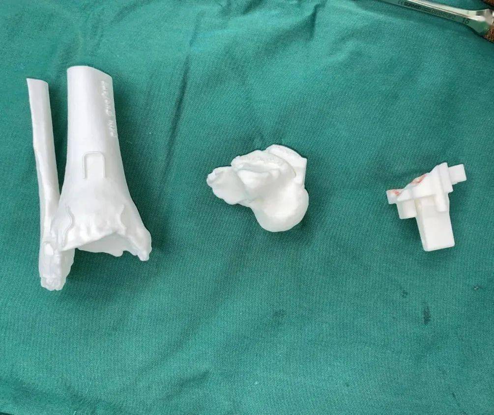 北京积水潭医院足踝外科完成国内首例定制化人工全踝关节置换_患者